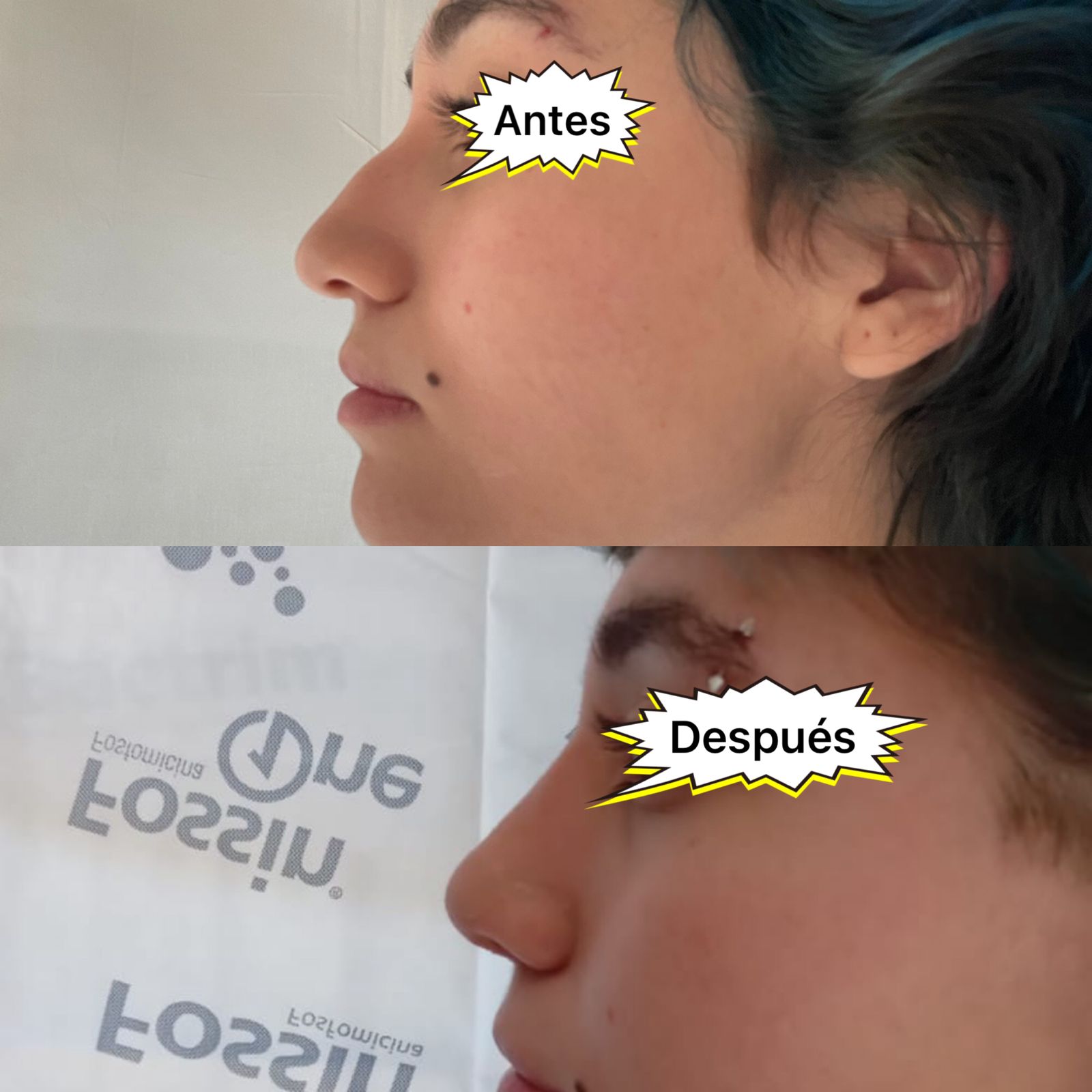 Cirugia Estetica de Nariz - Otorrinolaringología Especializada